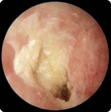 Candida Albicans grzybica ucha vegatest warszawa